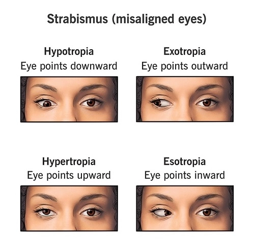 Eye Misalignment- Strabismus